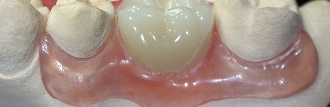 Dentaltechnik Heinrici unsichtbarer Zahnersatz